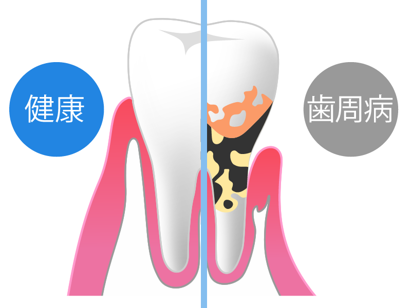 歯周病と健康な歯
